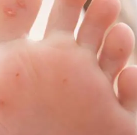 若是足部有瘙痒用手抓还会有破皮跟水泡那么应该是真菌感染使得脚部出现了足癣