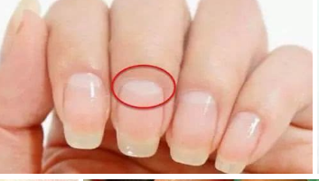 指甲上月牙小是身体出问题的表现吗