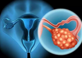 卵巢癌是女性生殖器官常见的肿瘤之一