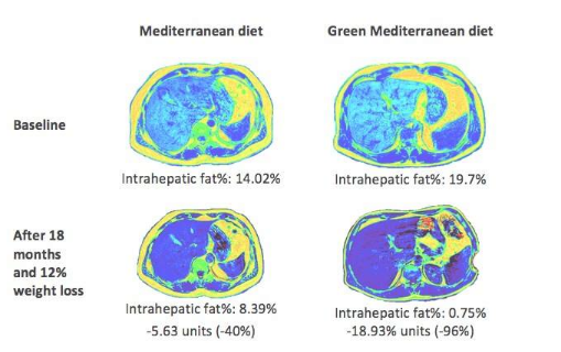 绿色地中海饮食可将非酒精性脂肪肝的疾病减少一半