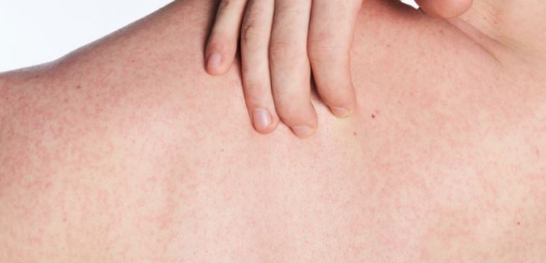 荨麻疹是一种非常常见的皮肤疾病