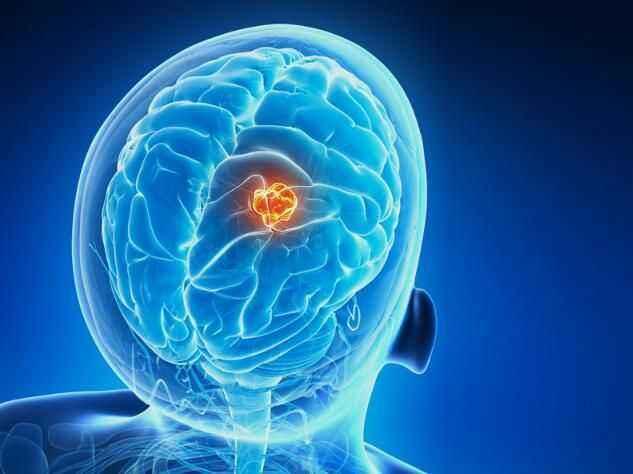 CNIO科学家发现一种用于治疗侵袭性脑肿瘤的联合疗法