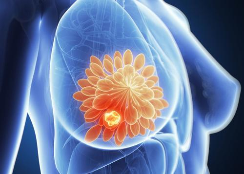 超重的乳腺癌幸存者罹患第二原发癌的风险在统计学上显着增加