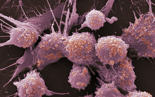 科学家开发出可摧毁癌细胞肾细胞的创新技术