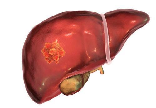 研究发现非酒精性脂肪肝患者患肝癌的风险增加