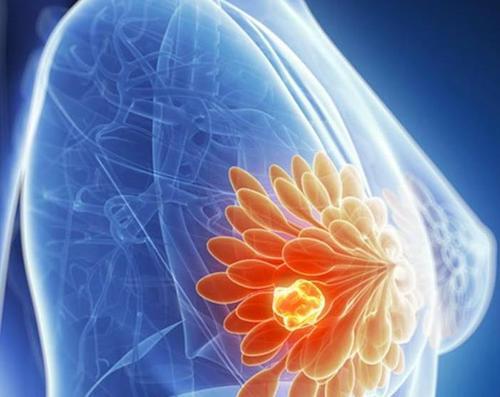 研究人员发现刺激乳腺癌基因活性的超级增强剂