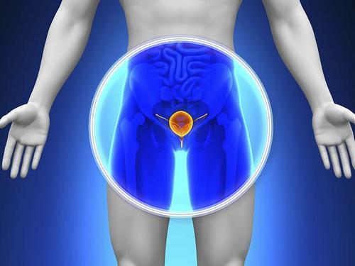 新的前列腺癌尿液测试显示出侵袭性疾病有多严重