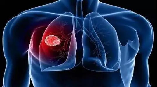 新研究为早期识别与治疗肺癌提供了新的见解