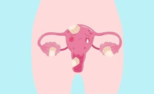 新理论可能会彻底改变子宫内膜异位症的治疗方法