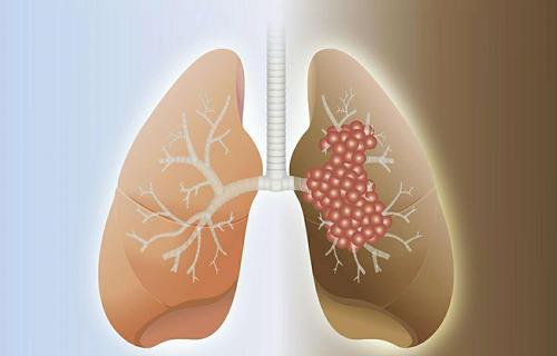 延迟肺癌手术与更高的复发 死亡风险相关