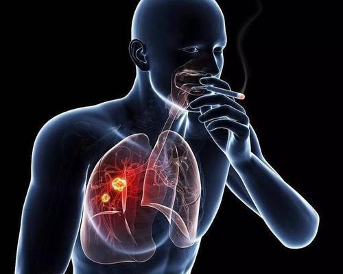 靶向pralsetinib可安全有效地治疗具有RET改变的肺癌和甲状腺癌