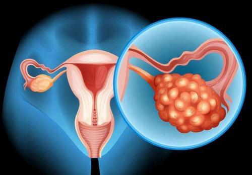 模型表明对于特定的卵巢癌患者手术应先于化疗