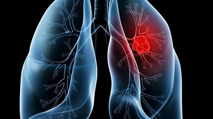 肺癌的独特特征可能是个性化治疗的关键