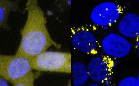 新研究发现阿尔茨海默氏症的淀粉样蛋白和Tau蛋白起as病毒作用