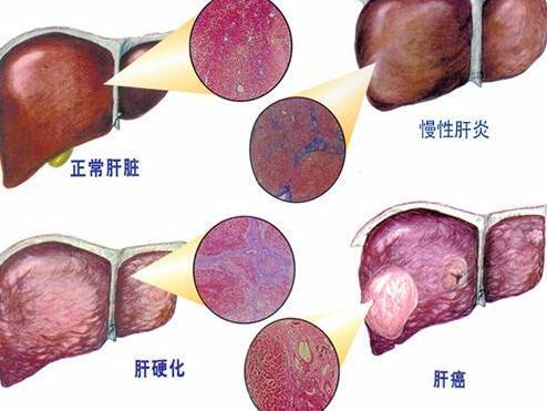 小鼠中发现的再生机制可能为对抗慢性肝病的药物提供靶标