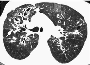 科学家们发现了一种新方法 可以治疗囊性纤维化