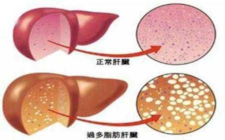 与肥胖和脂肪肝疾病有关的排毒相关酶