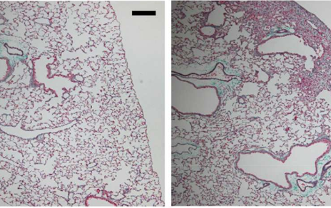 研究人员确定了肺纤维化的新治疗靶标