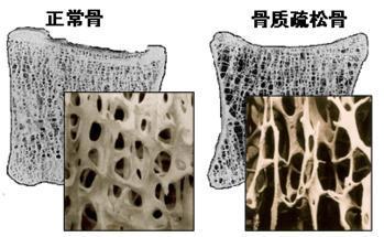 英国的骨质疏松症治疗率不再上升