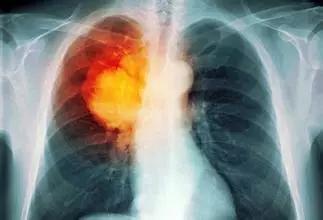 Dacomitinib治疗晚期肺癌的缺点超过生存优势