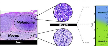 MicroRNA生物标志物使黑色素瘤的诊断更加客观