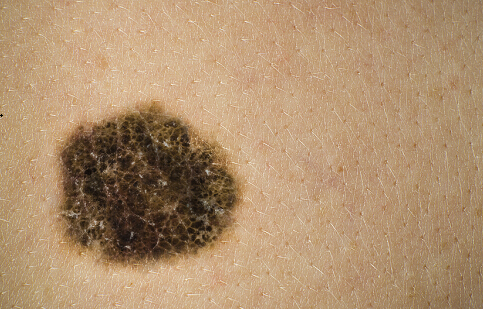 冷冻疗法加咪喹莫特有效治疗皮肤黑色素瘤