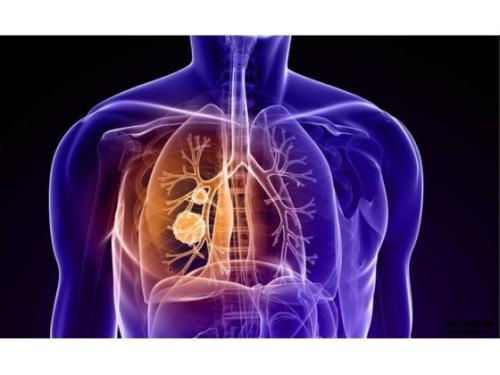 添加savolitinib至osimertinib对某些预治疗的肺癌患者有益
