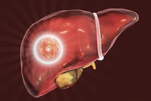 专家们开发了一个简单的问卷 以提高人们对管理肝脏疾病的认识