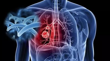 肺癌引发肺动脉高压