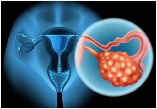 循环肿瘤DNA为最常见的卵巢癌类型提供治疗选择