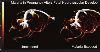 孕期孕妇疟疾导致后代认知缺陷