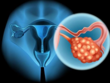新发现可能会改变对卵巢癌的认识和治疗