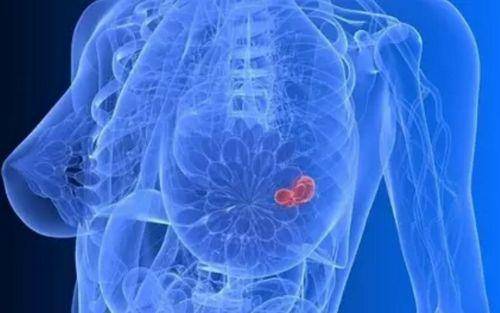 新方法可识别侵袭性乳腺癌