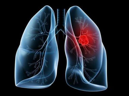 非小细胞肺癌和恶性相关的胸腔积液分泌物