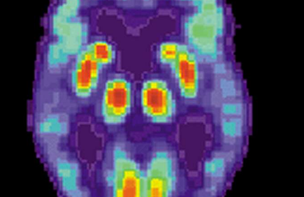 对大脑结构的新研究突显出与阿尔茨海默氏症和自闭症有关的细胞