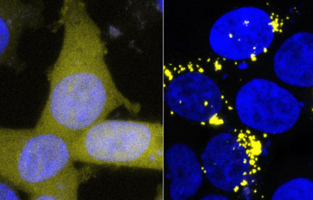 新研究发现阿尔茨海默氏症的淀粉样蛋白和Tau蛋白起as病毒作用