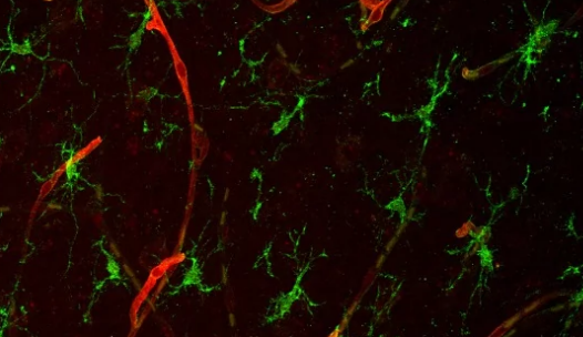 科学家鉴定出促进脑转移的蛋白质