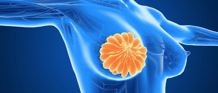 新辅助治疗后残留的癌症负担可以准确预测乳腺癌的存活率