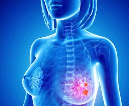 国家临床试验为复发性乳腺癌提供了乳房切除术的替代方案