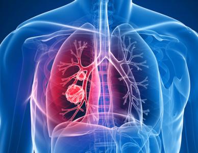 佐治亚州为肺气肿提供新的微创治疗