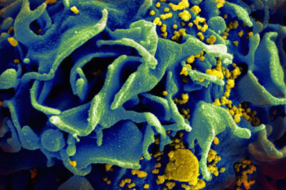研究人员说 第二名患者被治愈了艾滋病毒