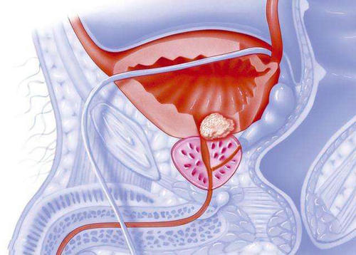确定前列腺癌患者耐药性的主要原因