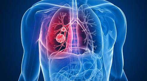 为难以治疗的肺癌解锁治疗