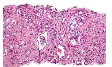 结合活检方法的测试可改善前列腺癌的诊断