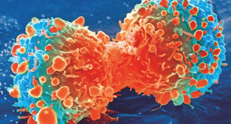 研究揭示了为什么某些前列腺癌更具侵略性