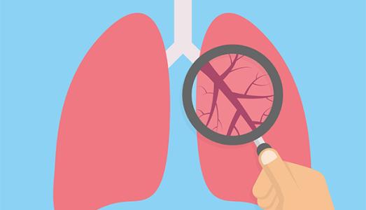 谢菲尔德的研究发现 癌症药物可能会治疗COPD