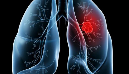 发现不同的肺癌途径可能会导致更有针对性的治疗