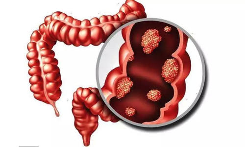 FDA批准的药物可修复与溃疡性结肠炎有关的肠道渗漏
