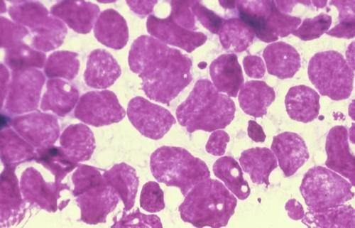 靶向特定的组蛋白脱乙酰酶可能是非小细胞肺癌的新型治疗策略
