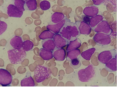 研究显示急性淋巴细胞白血病注定会复发的细胞特性